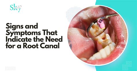 Root Canal Signs Symptoms That Indicate The Need For A Root Canal