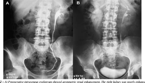 Figure 2 From Laparocopic Ureteral Reimplantation In Ureteral Stenosis