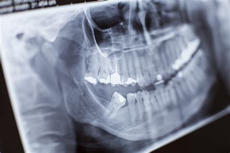 Diga Xis Saiba A Import Ncia Da Radiologia Odontol Gica Cl Nica