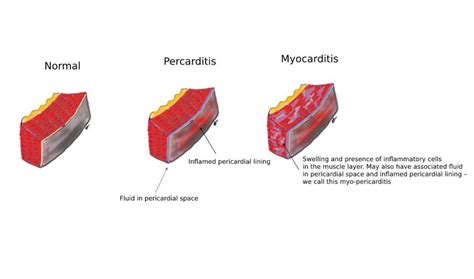 learning   myocarditis  pericarditis medicus network