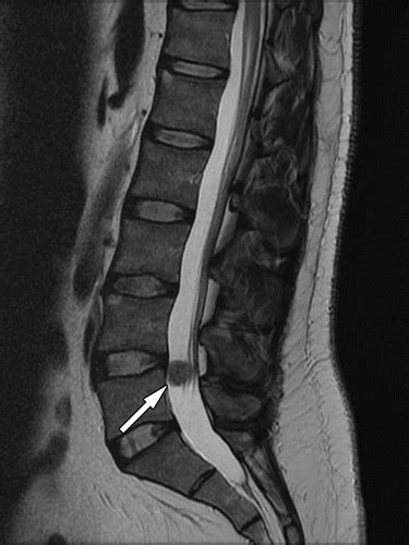 Intradural Extramedullary Spinal Neoplasms Radiologic Pathologic