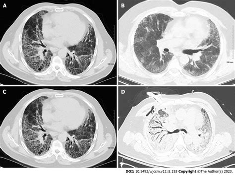 Acute Interstitial Pneumonia