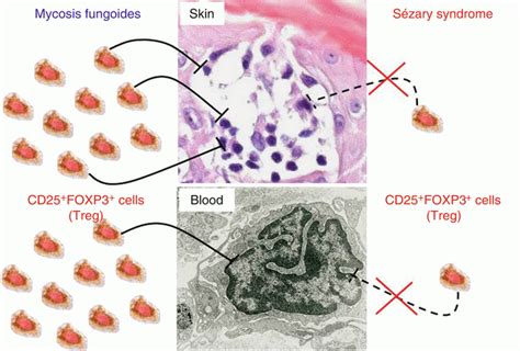 Personalized Treatment In Cutaneous T Cell Lymphoma Ctcl Plastic