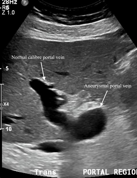 Portal Vein Ultrasound