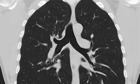 The Visualizing Power Of CT Scans For Chest In High Detail Kiran Lab