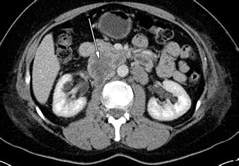 Retroperitoneal Leiomyosarcoma From The Radiologic Pathology Archives