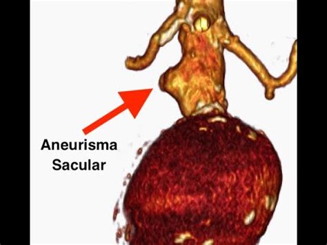 Aneurismas Sacular E Fusiforme Tratados Por Implante De Endopr Tese E