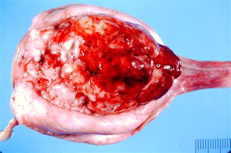 Transitional Cell Carcinoma Pathology And Ponies