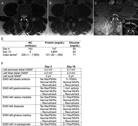 Figure Lumbar spine MRI obtained on hospital day 2 demonstrating nerve ...