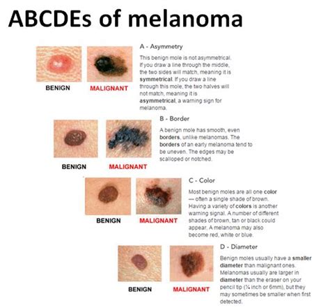 Melanoma Skin Cancer Stages