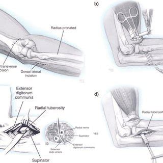 PDF Distal Biceps Tendon Injuries