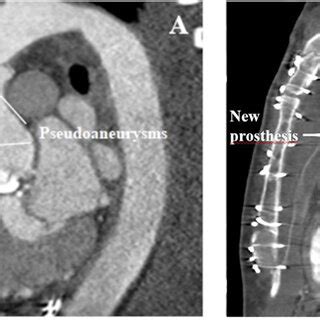 Preoperative Computed Tomography CT Scan With Pseudoaneurysms And