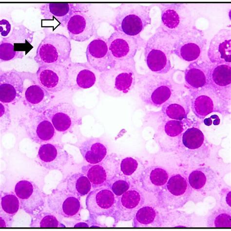 Fine Needle Aspiration Cytology Fnac For The Diagnosis Of Ctvt