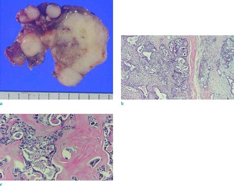 High Grade Mucoepidermoid Carcinoma Ex Metastasizing Pleomorphic Adenomas In The Parotid Gland