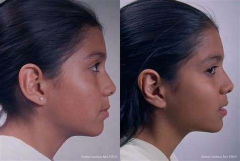 Otoplasty And Earlobe Repair Before After Gallery Patient