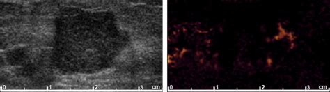 Computer Aided Diagnosis For Breast Tumors By Using Vascularization Of