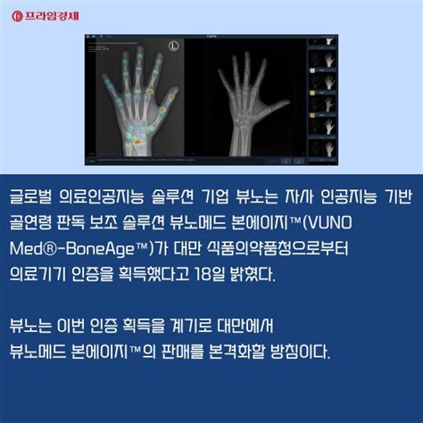 카드 뷰노 Ai 골연령 판독 솔루션 대만 진출 네이트 뉴스