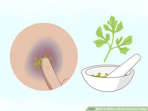 Ways To Make A Bruise Go Away Faster Wikihow