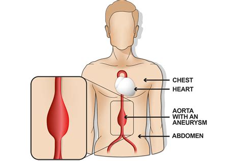 Your Screening Results You Have A Medium Abdominal Aortic Aneurysm Aaa Gov Uk