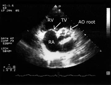 parasternal short axis view    side   heart  shows