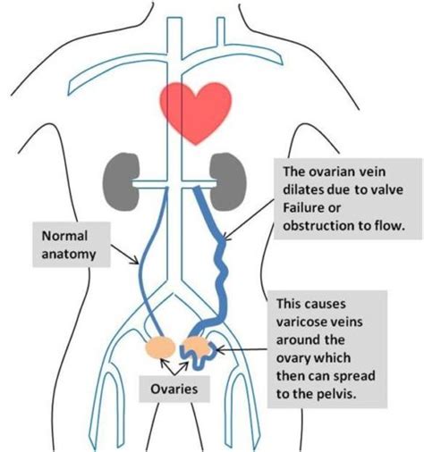 Pelvic Venous Congestion Treatment Options