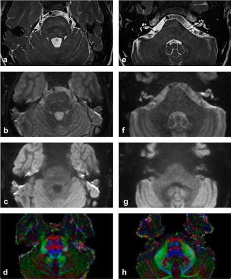 Frontiers Clinical Applications For Diffusion Mri And Tractography Of