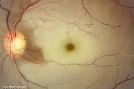 Arteri Le Retinale Occlusie Of Ooginfarct Eyeoffice Meulebeke