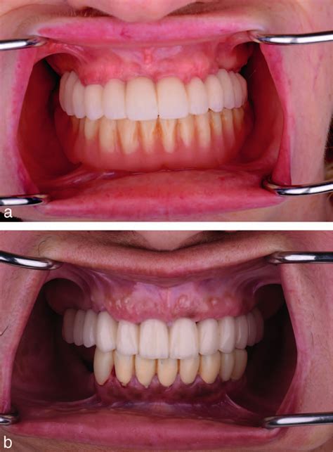 (a) Definitive bridge fixed in patient from immediate loading group ...