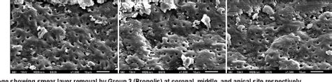 Figure 3 From Comparative Evaluation Of Smear Layer Removal Efficacy Of