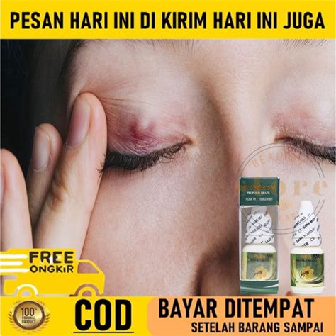 Jual Obat Kalazion Mata Obat Penghilang Benjolan Di Kelopak Mata