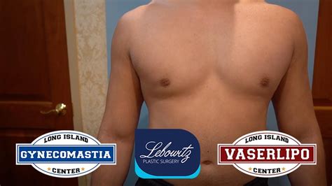 Gynecomastia Surgery On Las Vagas Male Vaser Hi Def 4d Liposculpture And Pectoral Lipofilling 💪🏼