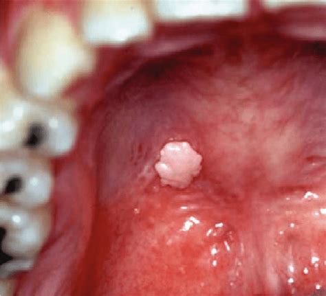 Clinical Photograph Of Case 16 From The Table Exhibiting A Sessile Download Scientific