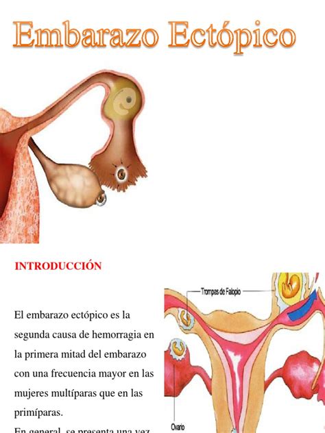 Embarazo Ectopico Presentacion Pdf El Embarazo Especialidades Medicas