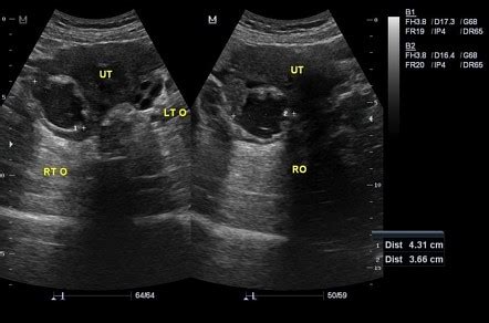 Hemorrhagic Ovarian Cyst Image Radiopaedia Org