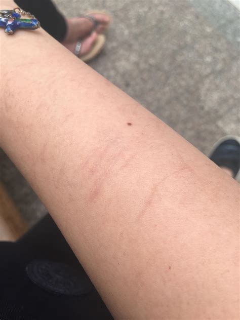 Skin Concern Played Too Hard With My Cat And Ive Had These Scars On My Arm For 8 9 Months Now