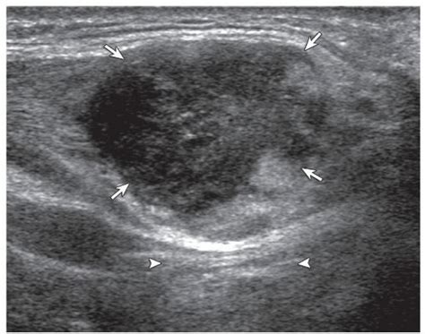 Malignant Fibrous Histiocytoma Undifferentiated Pleomorphic Sarcoma