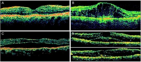 The Classification Of Diabetic Macular Edema According To Optical Download Scientific Diagram