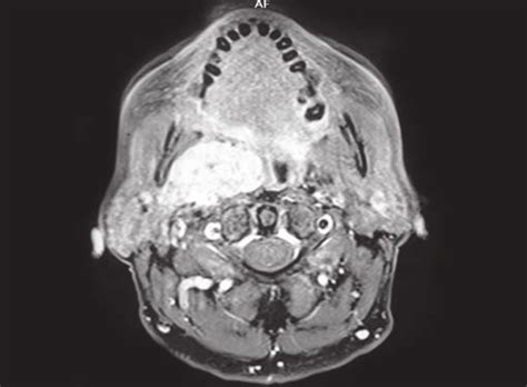 T1-weight MRI axial section showing mass in right parapharyngeal space | Download Scientific Diagram