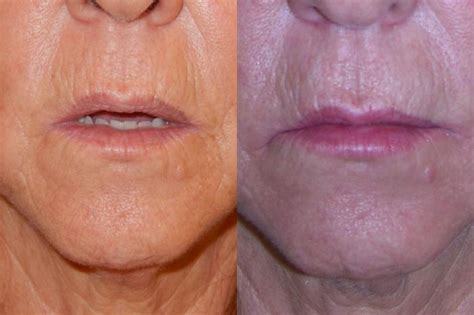 Dermal Fillers Before And After Photo Gallery Rochester Ny Q The Medical Spa