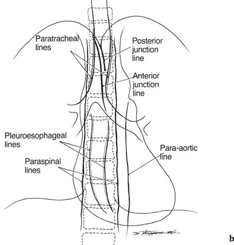 Mediastinal Or Hilar Enlargement Radiology Key