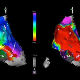 This Figure Shows Electroanatomic Maps In A Patient With Iart Post