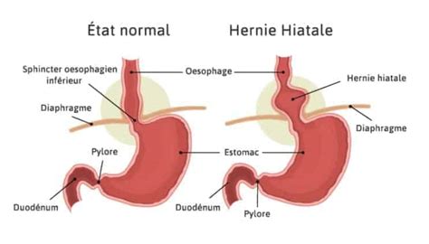 Traitement M Dical De La Hernie Hiatale Reflux Gastro Oesophagien