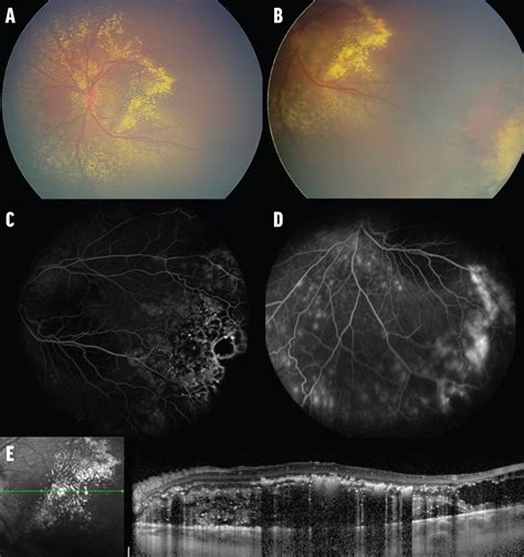 Coats Disease Whats New Retina Today