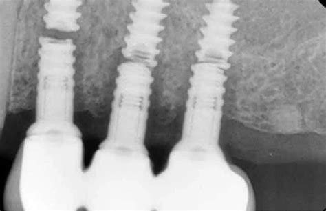 Implant Fracture MEDizzy