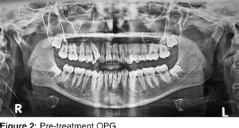 Figure 2 From Primary Tuberculous Osteomyelitis Of The Mandible A Rare Case Report Semantic