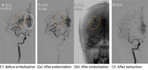 Target Disease Treatment｜cerebrovascular Department Department Of