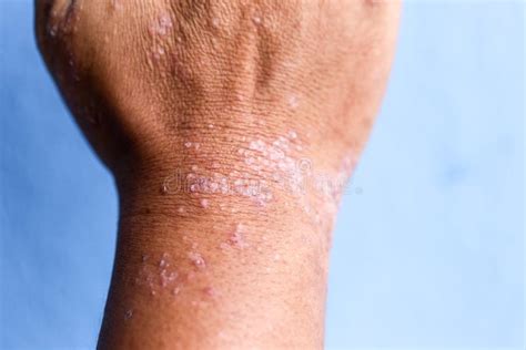 Atopic Dermatitis Ad Also Known As Atopic Eczema Is A Type Of