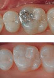 Amalgam Vs Composite Fillings Anchorage Dental Care