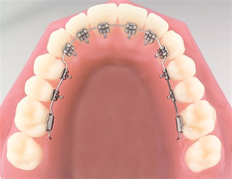 Win Lingual Braces Harley Street London Behind The Teeth Braces