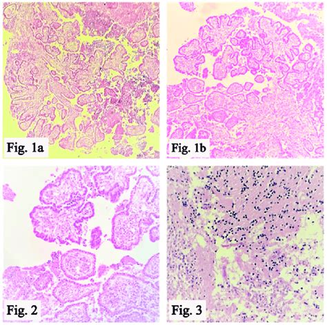 A 1b Tumor With Papillae H And E X100 Figure 2 Papillae Lined By